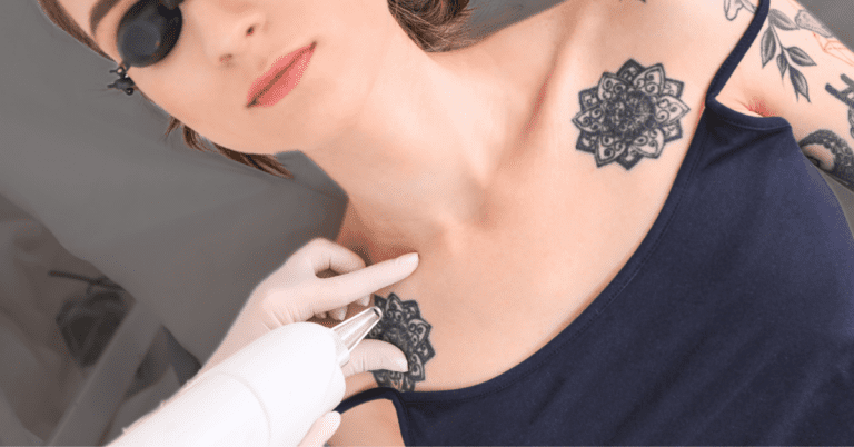 How Much Is Tattoo Removal?